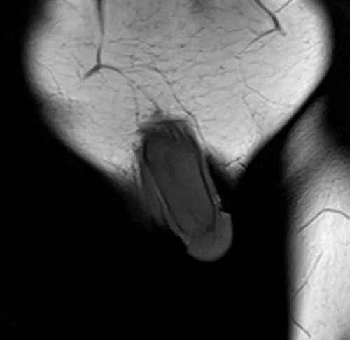 mri penis coronal t1 image 1 - MRI