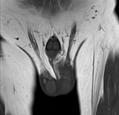 mri penis coronal t1 image 2 - MRI
