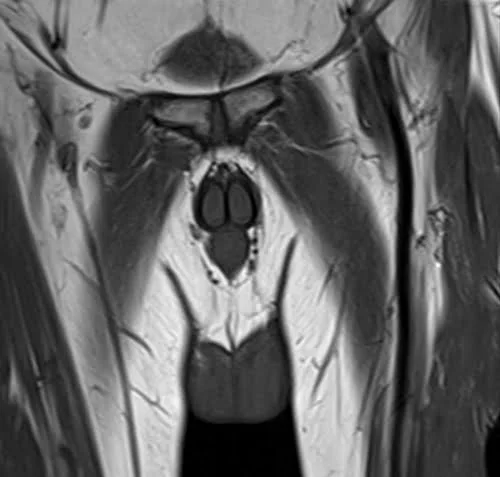 mri penis coronal t1 image 3 - MRI