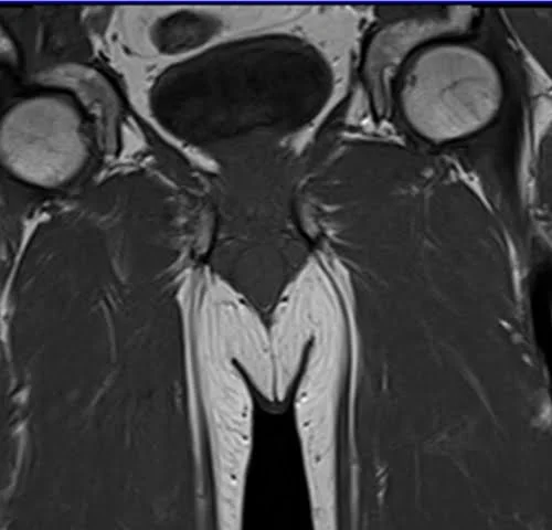 mri penis coronal t1 image 4 - MRI