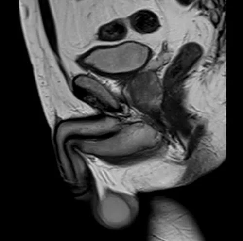 mri penis sagittal t2 image 1 - MRI