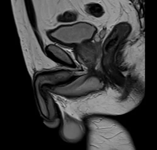 mri penis sagittal t2 image 2 - MRI