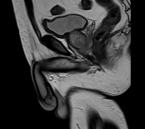 mri penis sagittal t2 image 3 - MRI