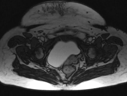 mri placenta axial birth canal t2 trufi image 3 - MRI