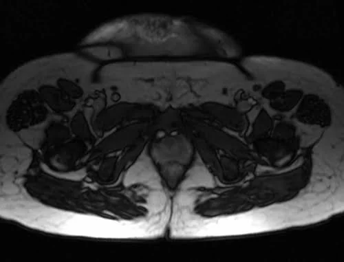 mri placenta axial birth canal t2 trufi image 4 - MRI