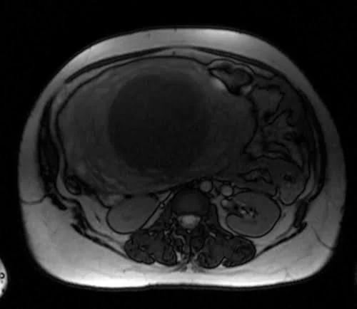 mri placenta axial t2 trufi image 1 - MRI