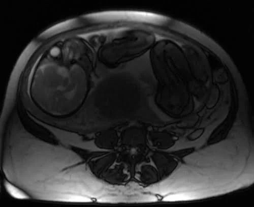 mri placenta axial t2 trufi image 2 - MRI