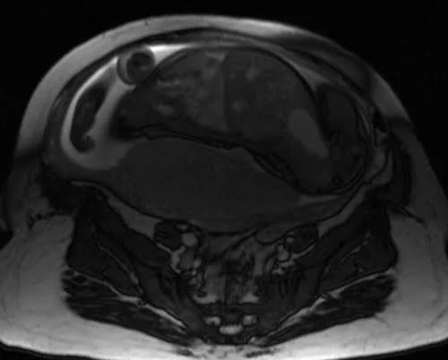 mri placenta axial t2 trufi image 3 - MRI