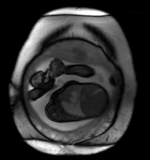 mri placenta coronal t2 trufi image 1 - MRI