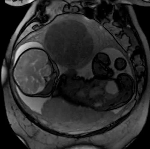 mri placenta coronal t2 trufi image 2 - MRI