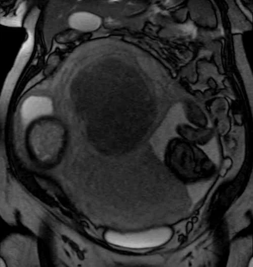 mri placenta coronal t2 trufi image 3 - MRI