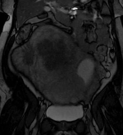 mri placenta coronal t2 trufi image 4 - MRI