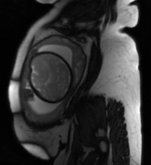 mri placenta sagittal t2 trufi image 1 - MRI