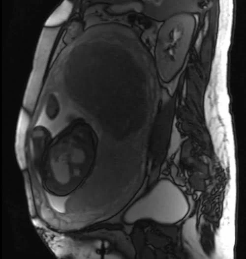 mri placenta sagittal t2 trufi image 2 - MRI