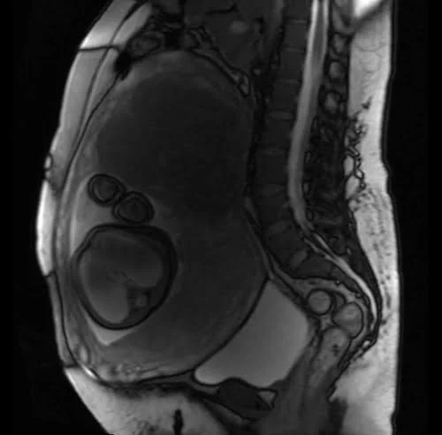 mri placenta sagittal t2 trufi image 3 - MRI