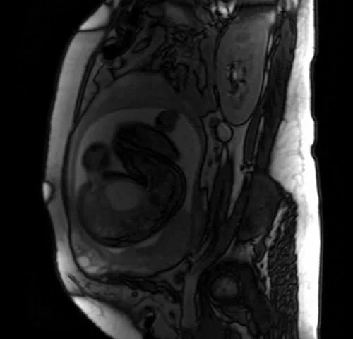 mri placenta sagittal t2 trufi image 4 - MRI