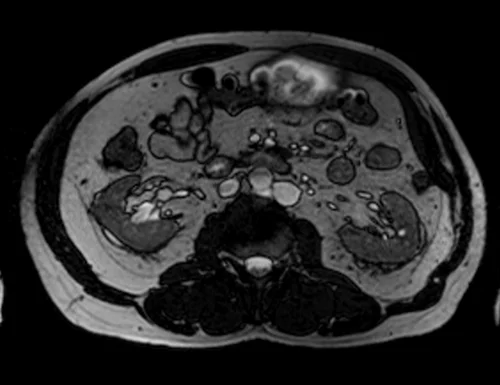 mri prostate localizer image 1 - MRI