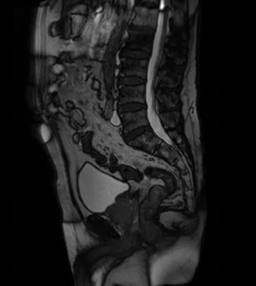 mri prostate localizer image 3 - MRI