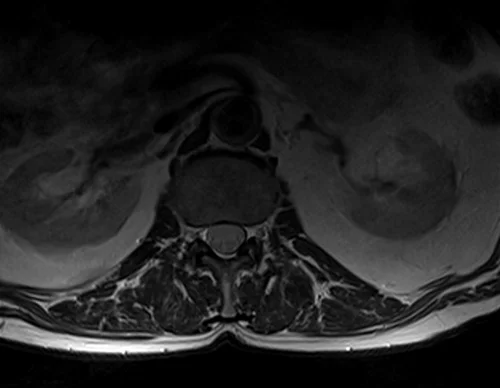 mri psoas muscle axial t2 image 1 - MRI