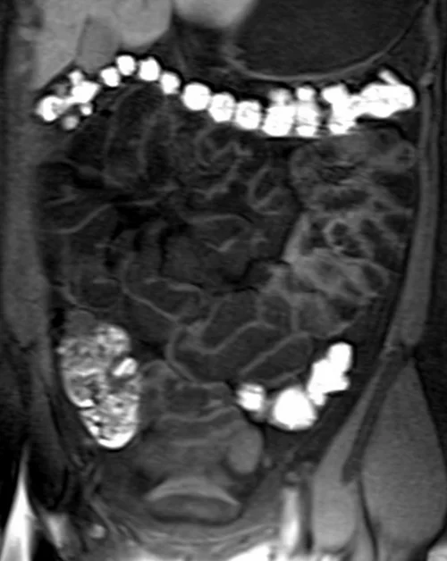 mri samall bowel coronal t1 flash image 1 - MRI