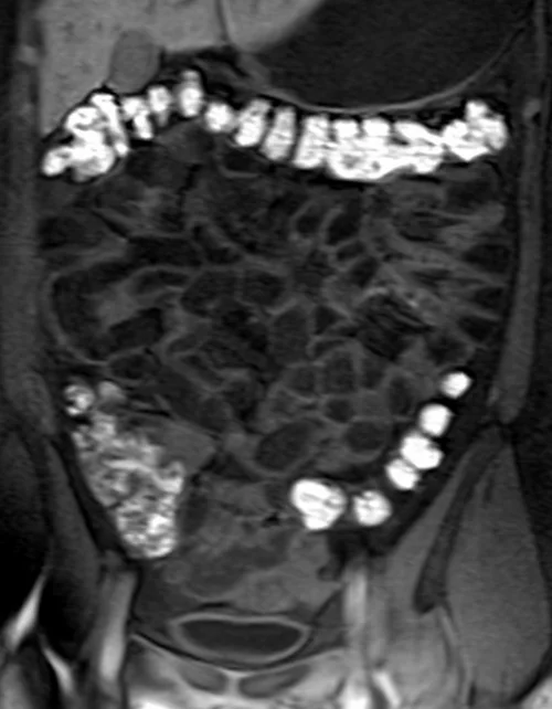 mri samall bowel coronal t1 flash image 2 - MRI