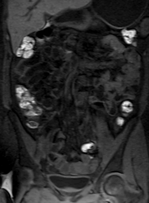 mri samall bowel coronal t1 flash image 3 - MRI