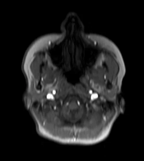 mri sialography axiallocalizer - MRI