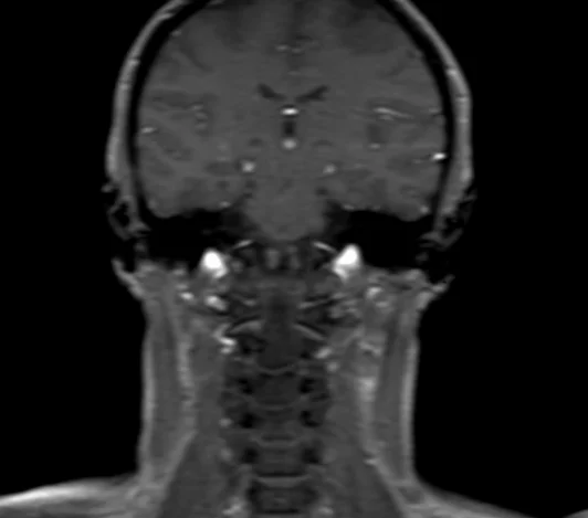 mri sialography coronal localizer - MRI
