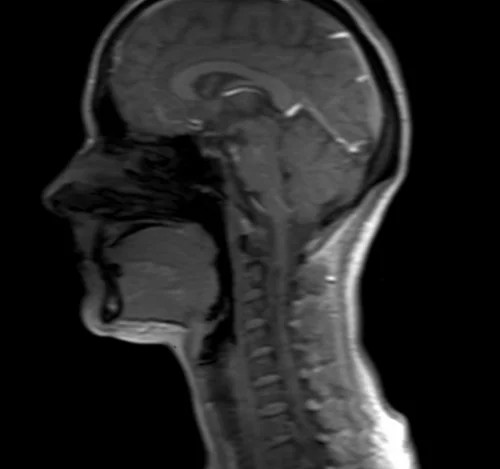 mri sialography sagittal localizer - MRI