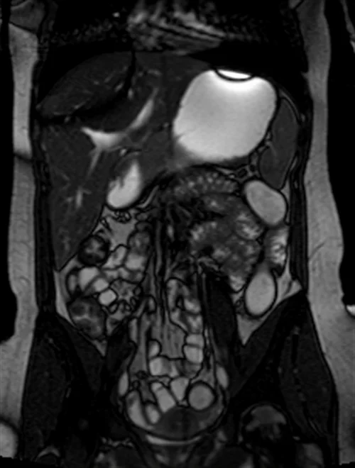mri small bowel localizer image 1 - MRI