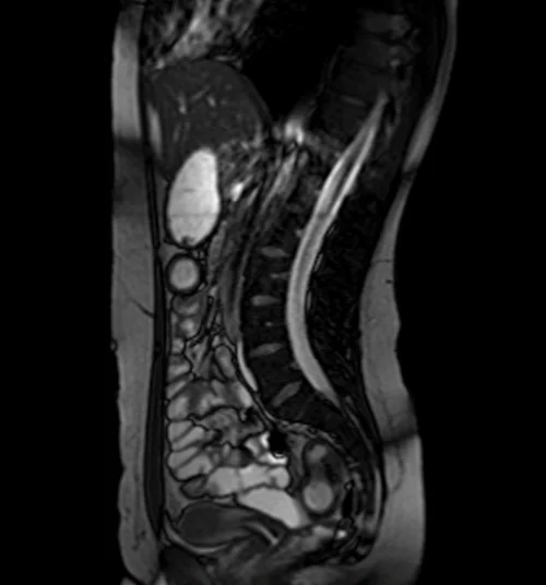 mri small bowel localizer image 2 - MRI