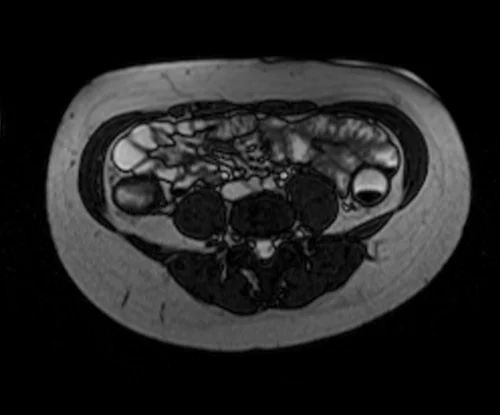 mri small bowel localizer image 3 - MRI
