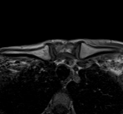 mri sternum axial t1 image 1 - MRI