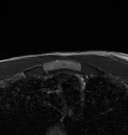 mri sternum axial t1 image 2 - MRI