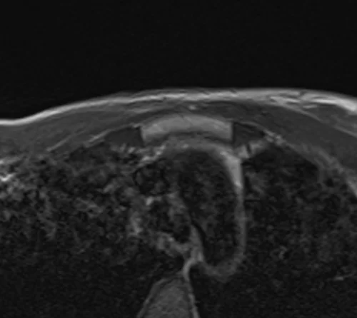 mri sternum axial t1 post gd image 2 - MRI