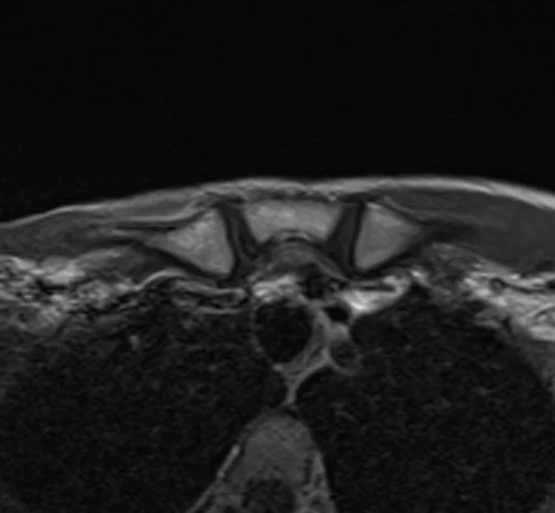 mri sternum axial t1 post gd image 3 - MRI
