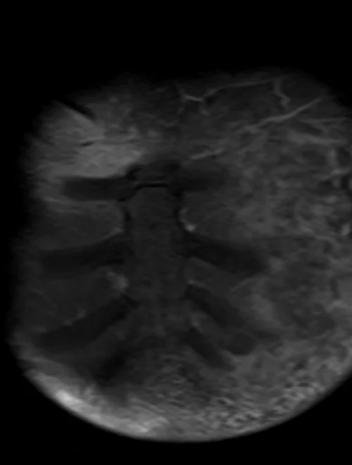 mri sternum coronal t1 post gd image 3 - MRI