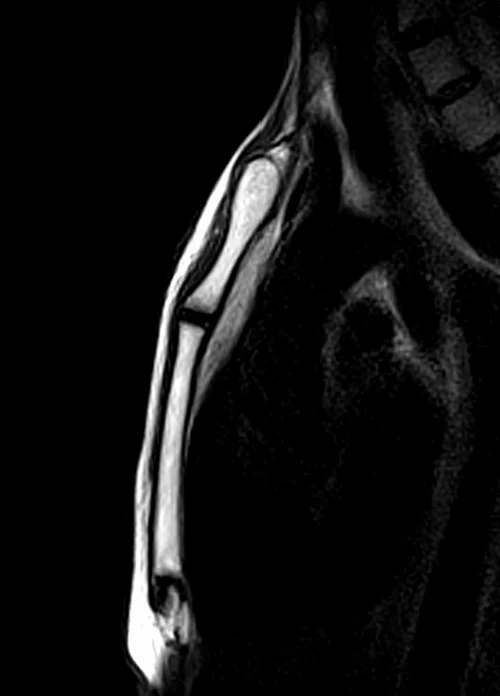 mri sternum sagittal t2 image 2 - MRI