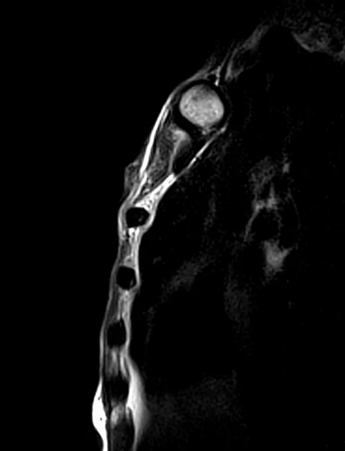 mri sternum sagittal t2 image 3 - MRI