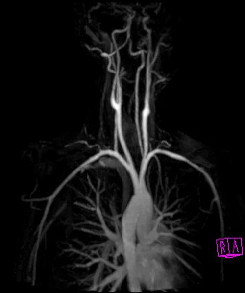 mri subclavian arm down mip 1 - MRI