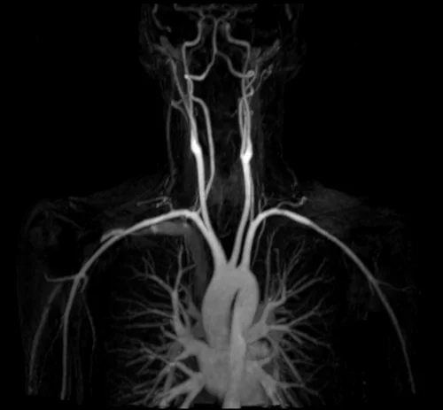 mri subclavian arm down mip 2 - MRI