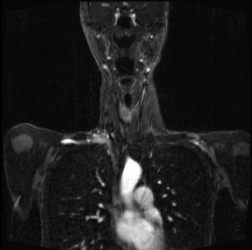 mri subclavian arm down post contrast image 1 - MRI