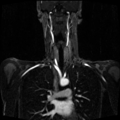 mri subclavian arm down post contrast image 2 - MRI