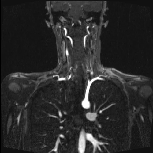 mri subclavian arm down post contrast image 3 - MRI