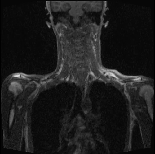 mri subclavian arm down pre contrast image 3 - MRI