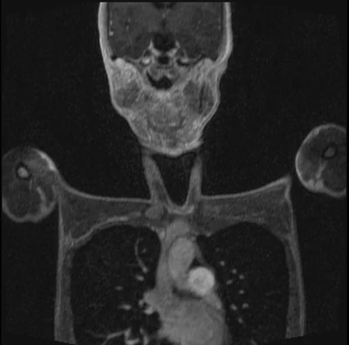 mri subclavian arm up pre contrast image 1 - MRI