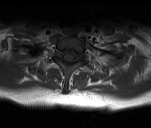 mri t spine axial t1 image 1 - MRI