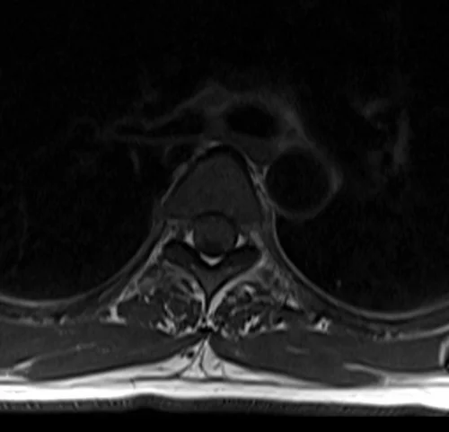 mri t spine axial t1 image 2 - MRI