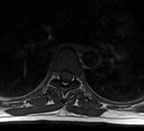 mri t spine axial t1 image 3 - MRI