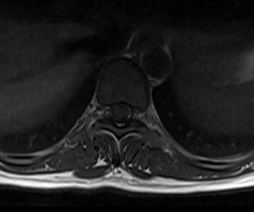 mri t spine axial t1 image 4 - MRI